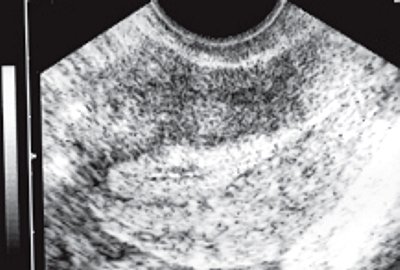 ТВУЗИ нормальной матки: продольное сканирование в области левого угла.