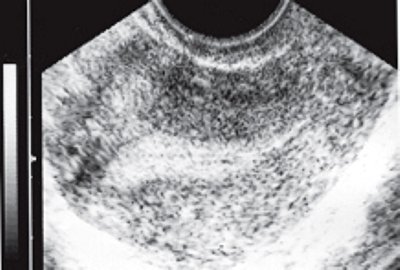 ТВУЗИ нормальной матки: продольное сканирование в области правого угла