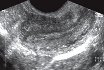 ТВУЗИ седловидной матки: продольное сканирование в области левого угла