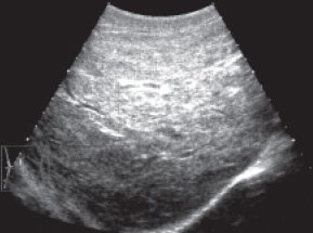 УЗИ: печень ребенка с муковисцидозом, паренхима плотная, сосудистый рисунок обеднен