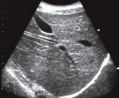 УЗИ: эхограмма печени при аутоиммунном гепатите при вирусном гепатите С