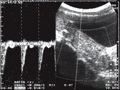 УЗИ: кровоток в стенке прямой кишки (импульсный допплер)