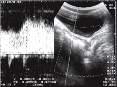 УЗИ: венозный шунтирующий кровоток в стенке прямой кишки (импульсный допплер)