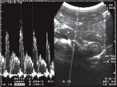 УЗИ: кровоток в стенке прямой кишки (импульсный допплер)