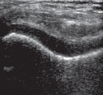 УЗИ: эхограмма суставного конца в норме