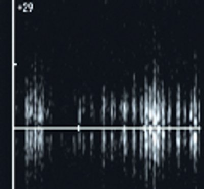 УЗИ: крупная 'флотирующая' ворсина синовиальной оболочки (спектральный допплер)