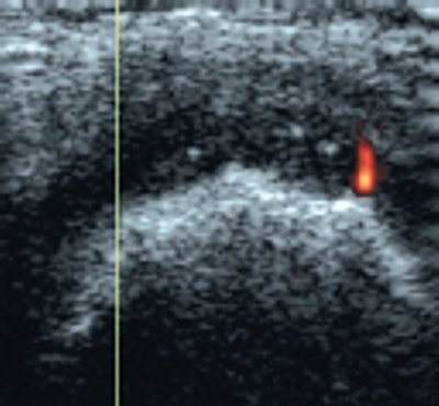 УЗИ: инвазия сосуда артериального типа в толщу поврежденного хряща