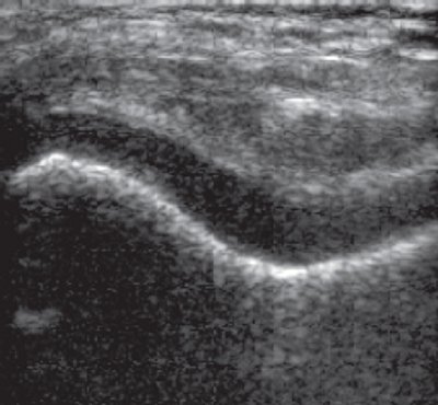УЗИ: фрагментация субхондрального слоя и локальное повышение звукопроводимости в зоне субхондрального перелома внутреннего мыщелка бедренной кости