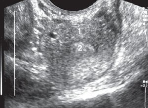 УЗИ: Ширина однорогой матки (3,4 см), поперечное трансвагинальное сканирование: 1-матка, 2-эндометрий