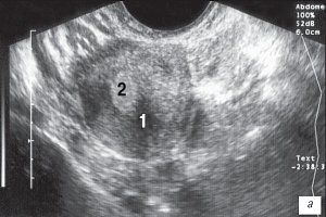 Эхограмма - асимметрия толщины боковых стенок матки 0,5 см, поперечное трансвагинальное сканирование (1 - матка, 2 - эндометрий)