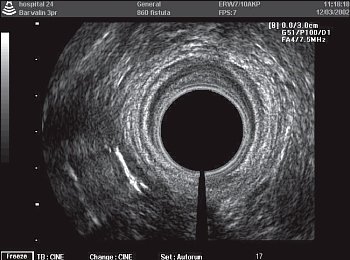 УЗИ: Часть чрессфинктерного свищевого хода на уровне средней трети анального канала справа и сзади от анального жома