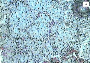 Микропрепарат, множественные пенистые (ксантомные) клетки, окраска гематоксилином и эозином