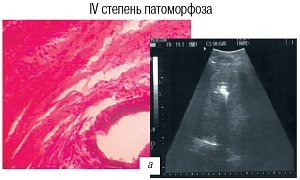 Граница зоны метастаза через 5 дней после электрохимического лизиса: IV степень патаморфоза