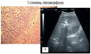 Граница зоны метастаза через 5 дней после электрохимического лизиса: I степень патаморфоза