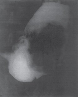 Рентгенограмма желудка