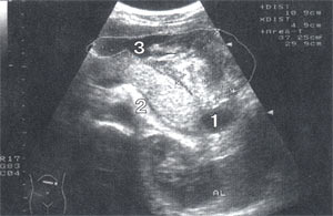 УЗИ: Эхограмма поджелудочной железы: 1-формирующаяся псевдокиста поджелудочной железы, 2-сдавленная селезеночная вена, 3-полостное образование в области сальной сумки