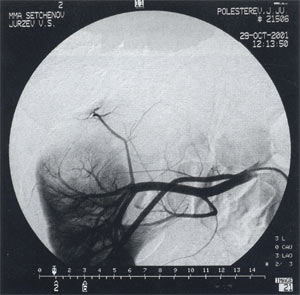 Селективная почечная артериограмма правой почки