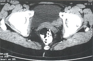 Компьютерная томограмма малого таза без контрастирования: Опухоль по задней стенке мочевого пузыря