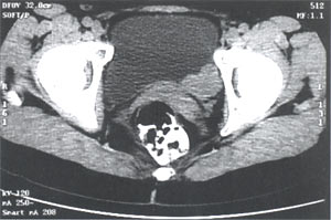 Компьютерная томограмма малого таза без контрастирования: Опухоль по задней стенке мочевого пузыря