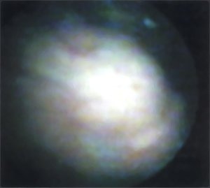 Цистоскопическая картина: Опухоль мочевого пузыря