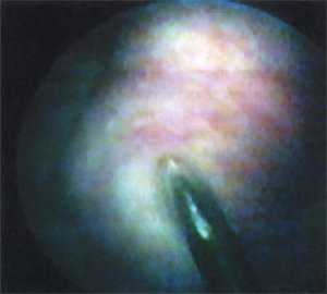 Цистоскопическая картина: Пункционная биопсия опухоли мочевого пузыря