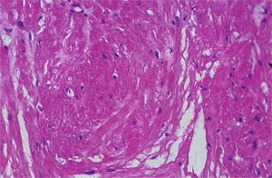 Патогистологическая картина биотата опухоли мочевого пузыря (х 200, окраска гематоксилин эозином)