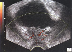 УЗИ. Рак предстательной железы после радикальной простатэктомии с инвазией в заднюю стенку мочевого пузыря (B-режим. Энергетический допплер)