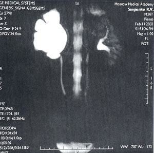 МР-урография: Стеноз лоханочно-мочеточникового сегмента справа, гидронефроз