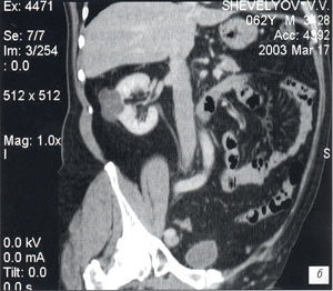 КТ: Образование жидкостной плотности в среднем сегменте почки с неровными конурами и перегородками, подозрение на опухоль