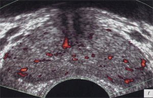 УЗИ: Хронический простатит с развитием везикулита, после лечения (Энергетический допплер)