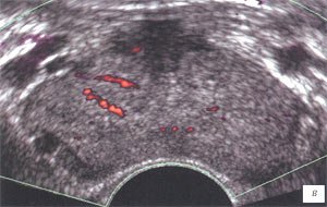 УЗИ: Хронический простатит с развитием везикулита, до лечения (Энергетический допплер)