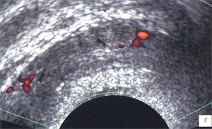 УЗИ: Cеменные пузырьки, после лечения (Сосуды. Энергетический допплер)