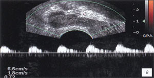 УЗИ: Артерии семенных пузырьков, до лечения (Импульсный допплер)