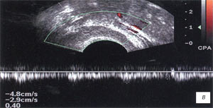 УЗИ: Артерии семенных пузырьков, после лечения (Импульсный допплер)