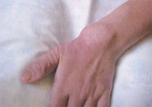 Фото: туберозный склероз, объемное образование в проекции лучезапястного сустава левой руки, изменения на коже первого пальца левой руки