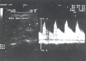 УЗИ: допплерограмма интраренального кровотока