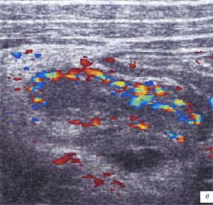 УЗИ: острый аппендицит - червеобразный отросток с воспалительной деструкцией (цветовой допплер)