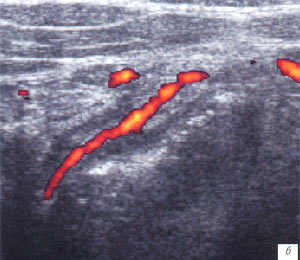УЗИ: гангренозно-перфоративный аппендицит (энергетический допплер)