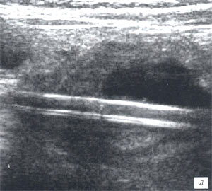 УЗИ: в просвете кишки определяется трубчатой формы структура длиной до 5 см, толщиной около 3,5 мм (В-режим)