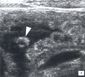 УЗИ: в просвете кишки определяется кольцевидной формы включение до 3,5 мм в диаметре, трудно дифференцируемое от фрагментов измененной слизистой кишки (В-режим)