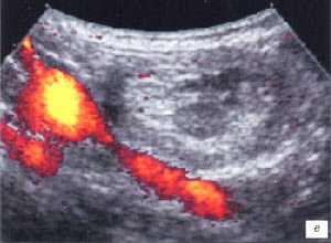 УЗИ: кишечная инвагинация, фрагмент крупного сосуда, внутри инвагината кровоток не визуализируется (энергетический допплер)