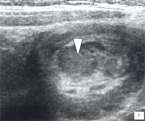 УЗИ: кишечная инвагинация, эхографический симптом мишени, в центре которой визуализируется лимфоузел с воспалительной трансформацией (B-режим)