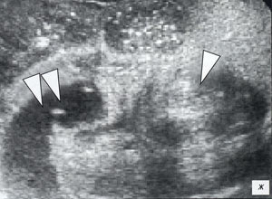 УЗИ: кишечная непроходимость у ребенка 18 месяцев на фоне тонко-толстокишечной инвагинации (B-режим)