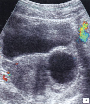 УЗИ: ребенок 12 лет, в проекции левых придатков определяется округлой формы включение до 48 мм в диаметре, тонкостенное, с жидкостным содержимым, без признаков кровотока внутри