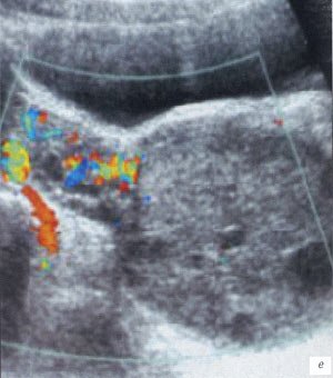 УЗИ: ребенок 2 лет, перекрут яичника (цветовой допплер)