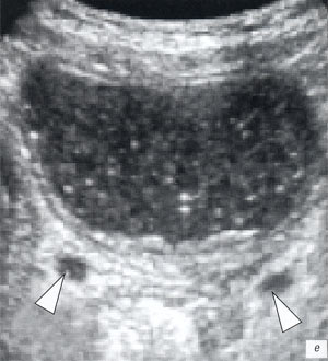 УЗИ: косвенные эхопризнаки цистоуретерита: стенка мочевого пузыря неравномерно утолщена, в его просвете - мелкодисперсная взвесь, определяется отек слизистой дистальных отделов мочеточников