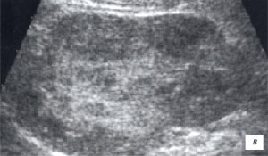 УЗИ: ребенок 2 лет, инфильтративная форма острого пиелонефрита (B-режим)