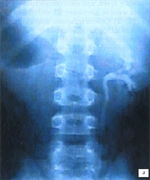 Экскреторная урография: на 6-минутном снимке функции правой почки нет