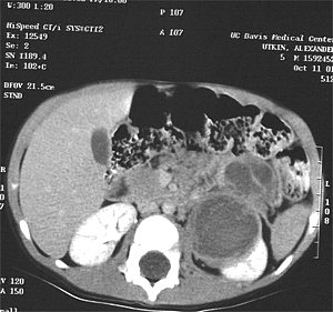 Рентгеновская компьютерная томограмма опухоли почки