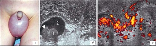 Изменения ткани мошонки у ребенка с острой почечной недостаточностью, острым гломерулонефритом